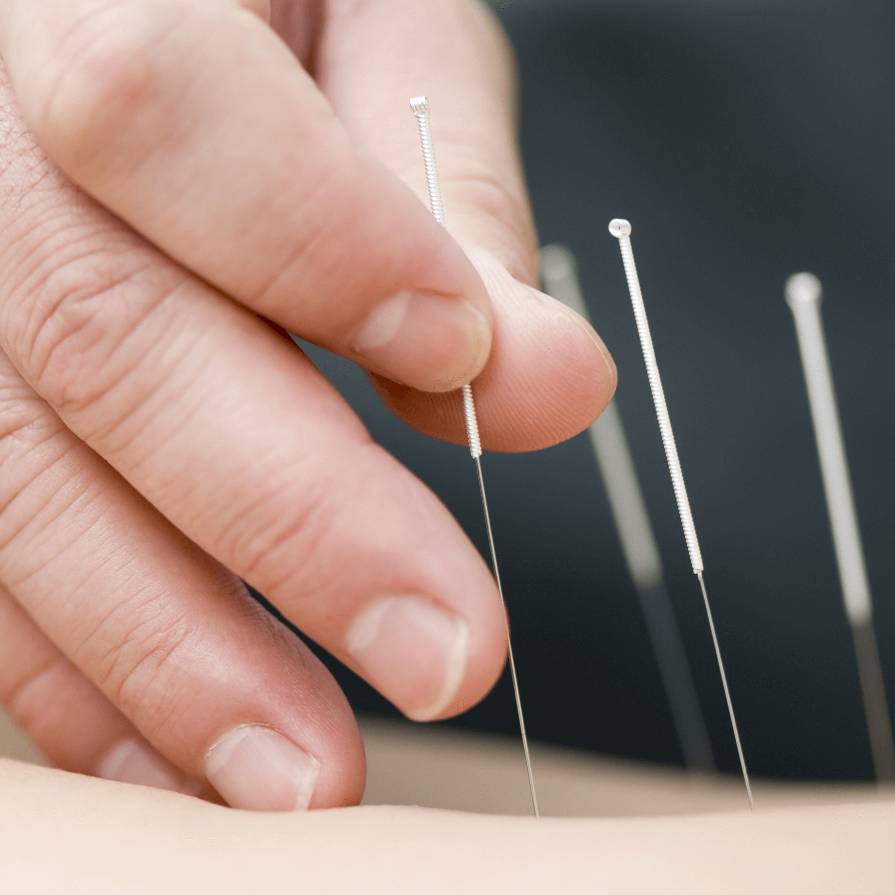 Doctor uses needles for treatment of the patient